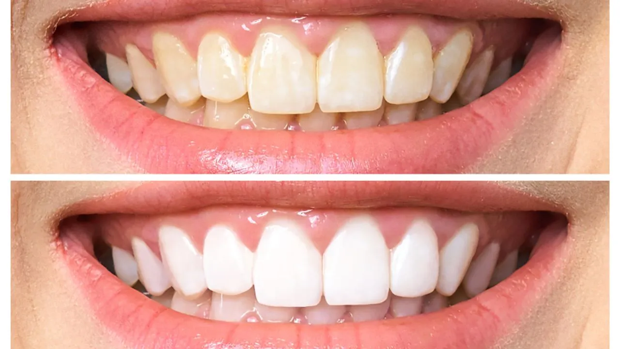 clareamento-dental-realce-o-brilho-do-seu-sorriso