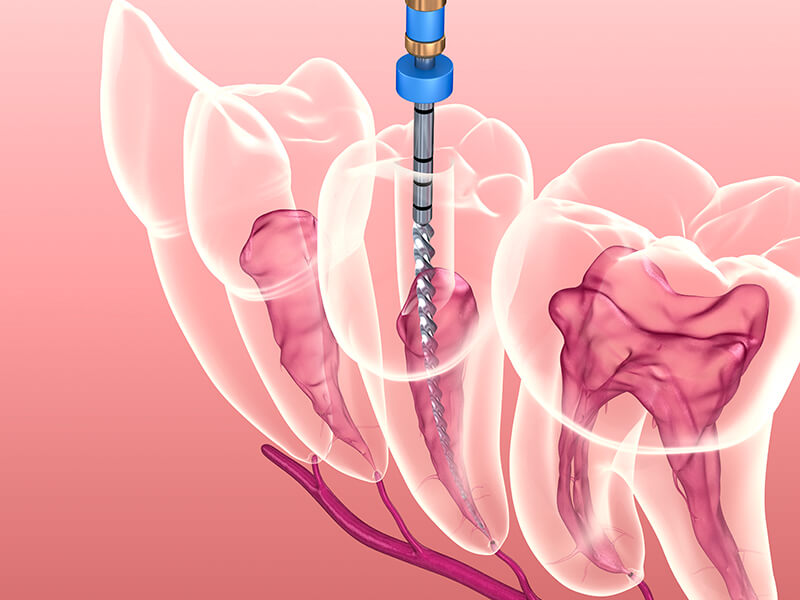 endodontia-tratamentos-de-canal-na-clinica-otd-odontologia-todo-dia-em-sao-paulo