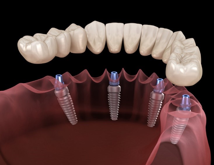 implantodontia-restaure-seu-sorriso-com-seguranca