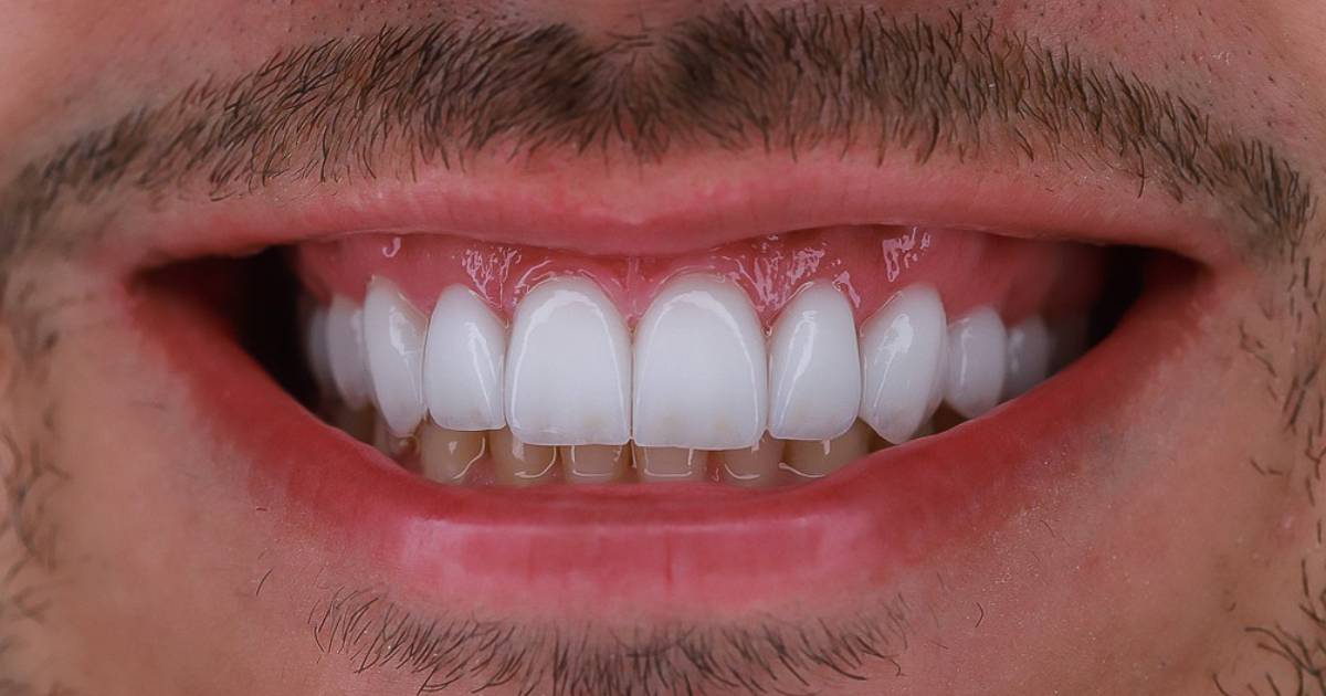 lente-dental-transforme-seu-sorriso-com-sofisticacao