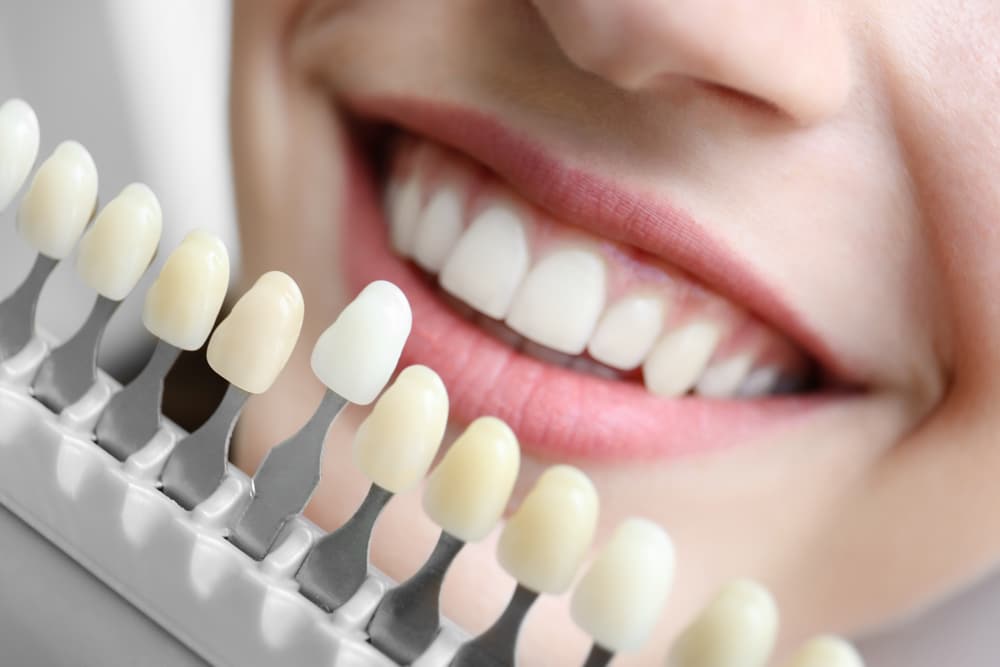 lente-dental-transforme-seu-sorriso-com-sofisticacao